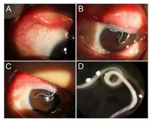 34岁农场男子眼痒难忍，眼科检查发现竟可能是因为养狗感染寄生虫