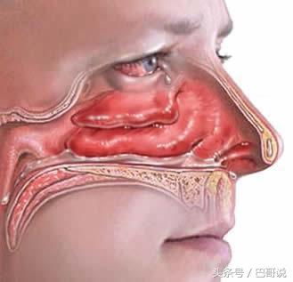 误区，养狗导致过敏性鼻炎是错误的，但过敏性鼻炎养狗会有影响